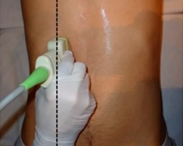 Ecografía abdominal